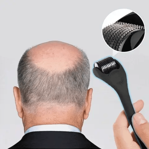 Derma Roller for Hair Growth - Elevate Scalp Health and Transform Your Hair